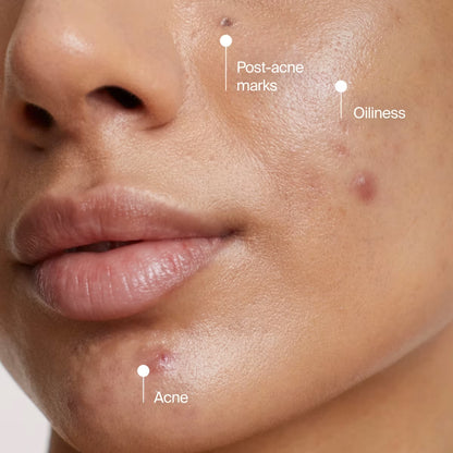 Neutrogena® Evenly Clear™ Acne Cleansing Mask, 4.2 Fl oz - US 9093