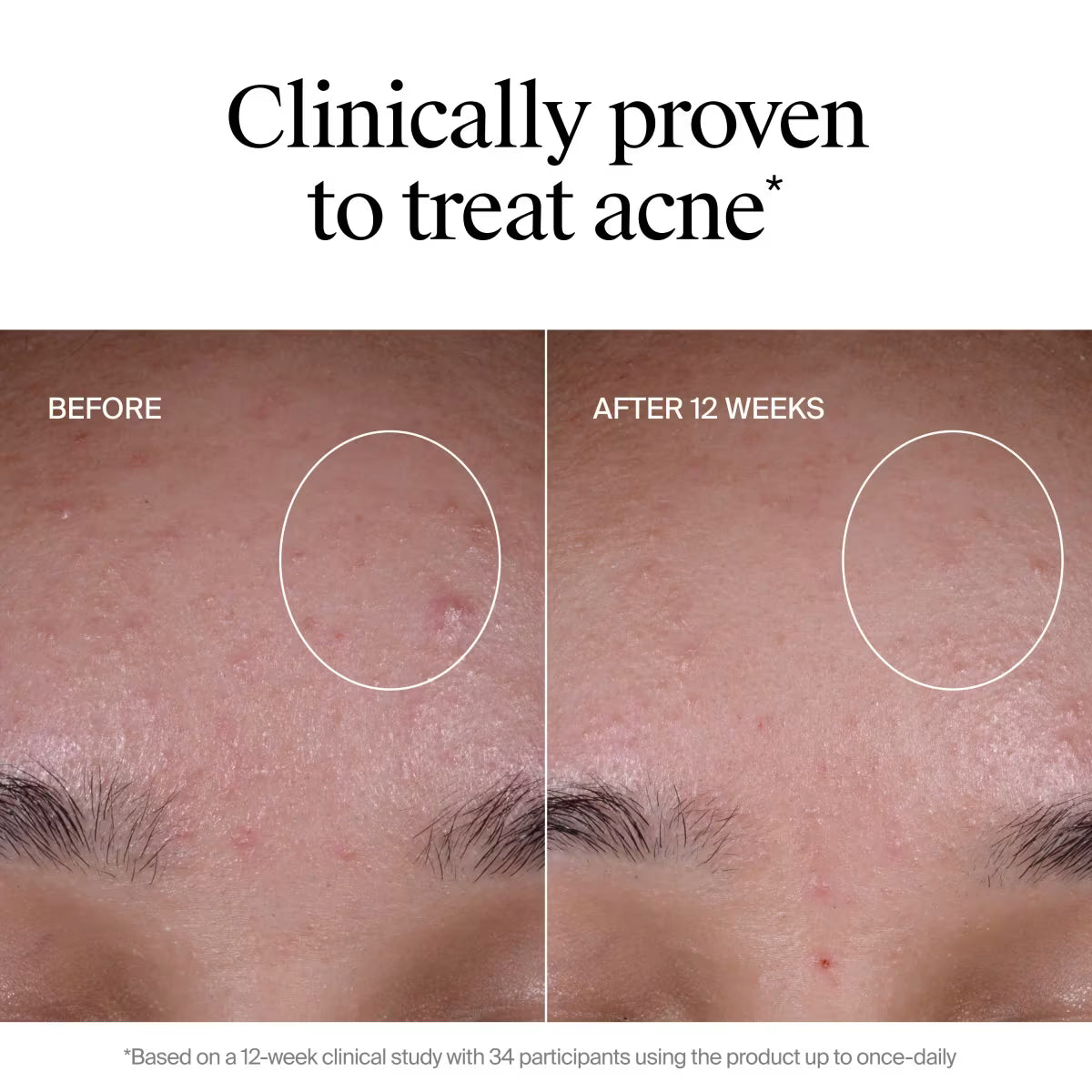 Neutrogena® Evenly Clear™ Acne Exfoliant, 1 fl oz - US 3768