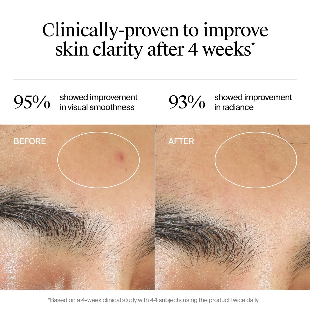 Neutrogena® Evenly Clear™ Acne Gel Moisturizer, 1.7oz - US 0712